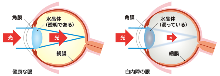 健康な眼と白内障の眼のイメージ図