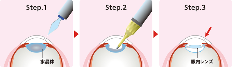 白内障手術方法のイメージ画像